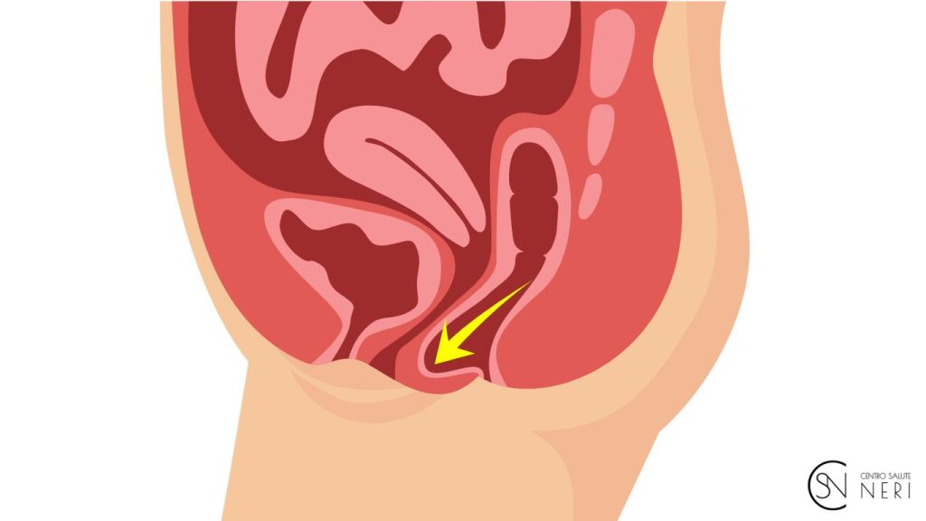 Il Prolasso degli Organi Pelvici: Sintomi, Cause e Soluzioni con la Riabilitazione del Pavimento Pelvico